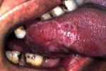 舌白斑症